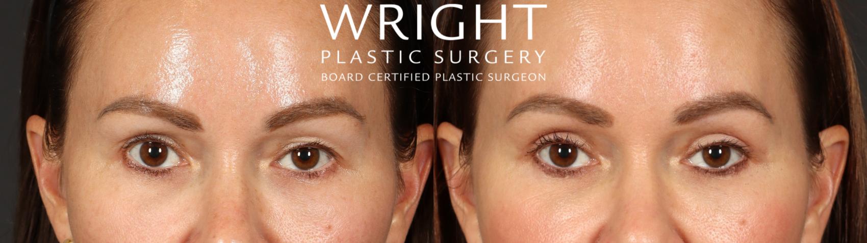 Before & After Blepharoplasty Case 683 Front View in Little Rock, Arkansas