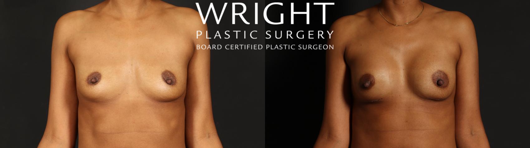 Before & After Breast Augmentation Case 594 Front View in Little Rock, Arkansas