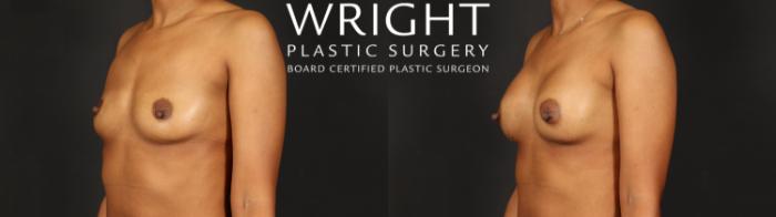 Before & After Breast Augmentation Case 594 Left Oblique View in Little Rock, Arkansas