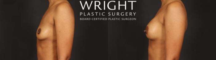 Before & After Breast Augmentation Case 594 Left Side View in Little Rock, Arkansas