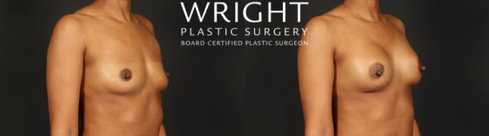 Before & After Breast Augmentation Case 594 Right Oblique View in Little Rock, Arkansas
