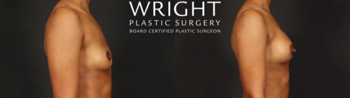 Before & After Breast Augmentation Case 594 Right Side View in Little Rock, Arkansas