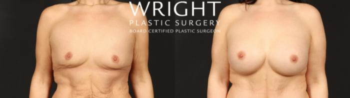 Before & After Breast Augmentation Case 659 Front View in Little Rock, Arkansas