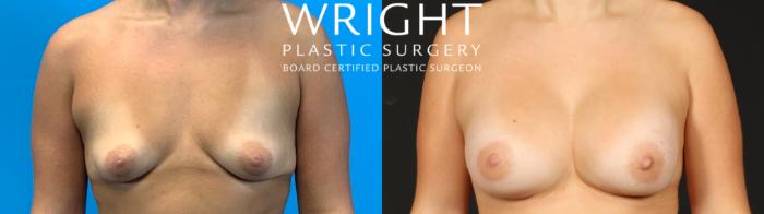 Before & After Breast Augmentation Case 671 Front View in Little Rock, Arkansas
