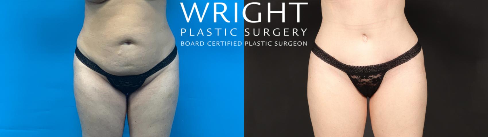 Before & After Tummy Tuck Case 593 Front View in Little Rock, Arkansas