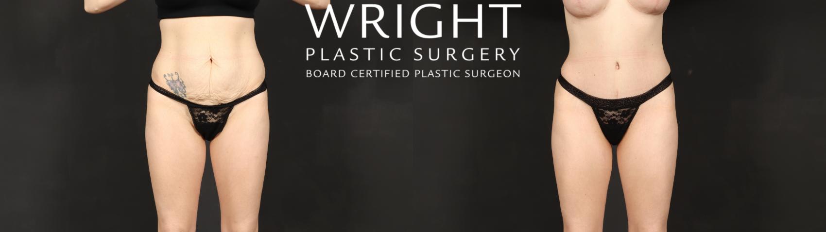 Before & After Tummy Tuck Case 595 Front View in Little Rock, Arkansas