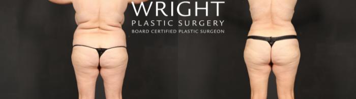 Before & After Tummy Tuck Case 597 Back View in Little Rock, Arkansas