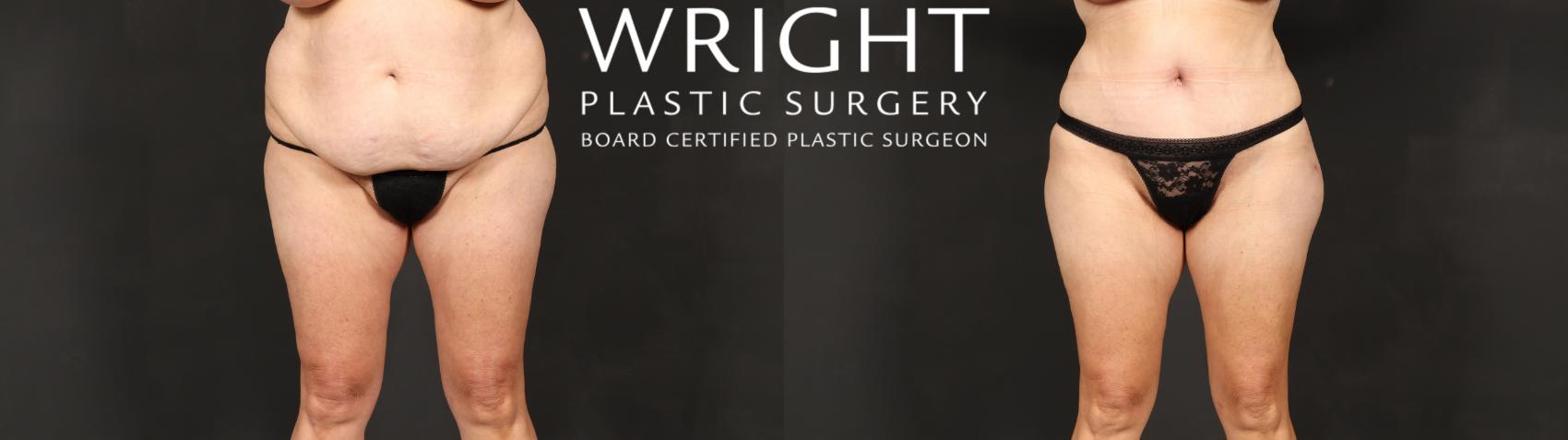 Before & After Tummy Tuck Case 597 Front View in Little Rock, Arkansas