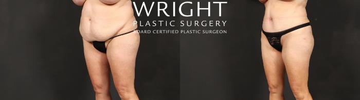 Before & After Tummy Tuck Case 597 Left Oblique View in Little Rock, Arkansas