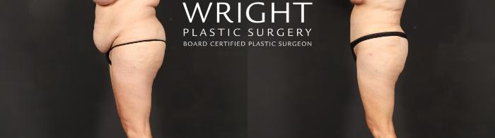 Before & After Tummy Tuck Case 597 Left Side View in Little Rock, Arkansas