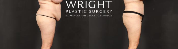 Before & After Tummy Tuck Case 597 Right Side View in Little Rock, Arkansas