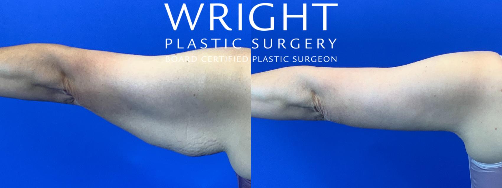 Before & After Liposuction Case 130 Back View in Little Rock, Arkansas