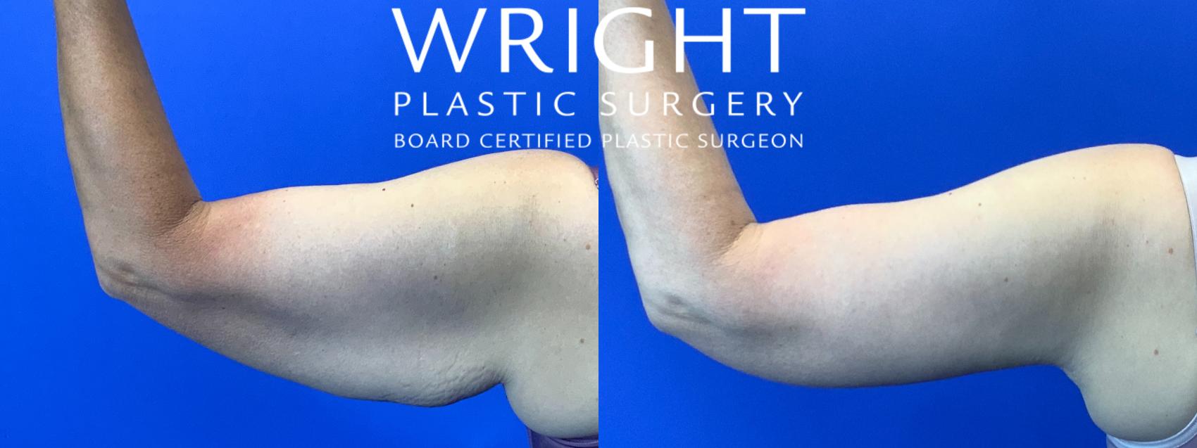 Before & After Arm Lift Case 130 Left Side View in Little Rock, Arkansas
