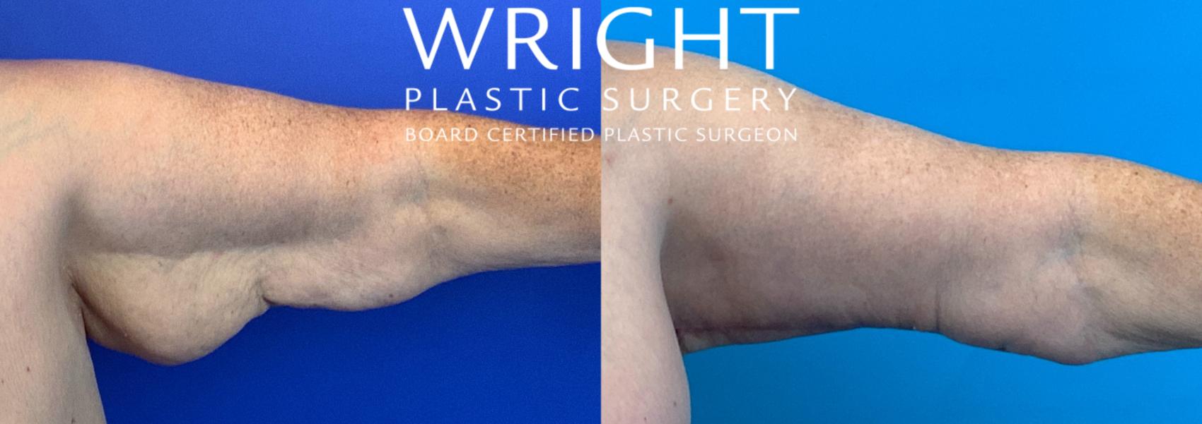Before & After Arm Lift Case 223 Right Side View in Little Rock, Arkansas