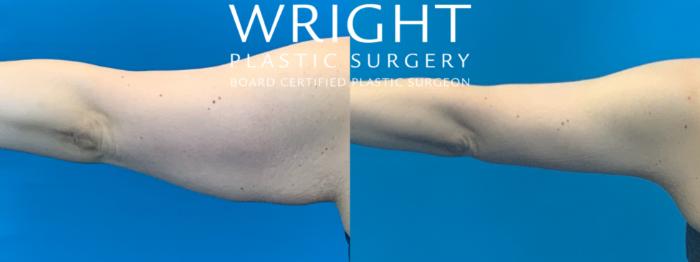 Before & After Liposuction Case 386 Back View in Little Rock, Arkansas