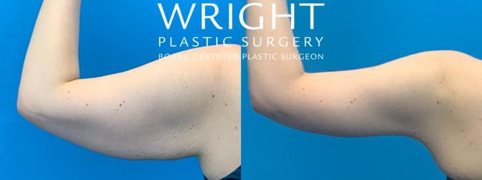 Before & After Arm Lift Case 386 Left Side View in Little Rock, Arkansas