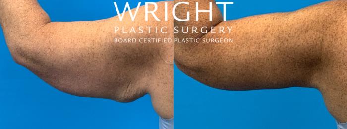 Before & After Arm Lift Case 395 Left Side View in Little Rock, Arkansas