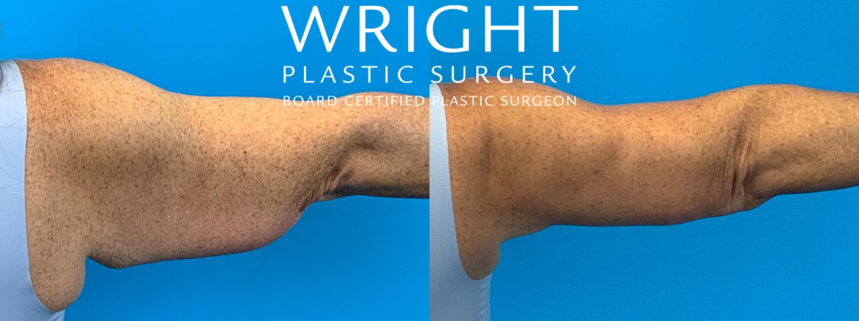 Before & After Arm Lift Case 395 Right Side View in Little Rock, Arkansas