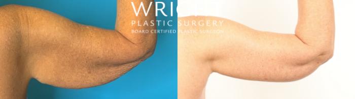 Before & After Arm Lift Case 424 Right Side View in Little Rock, Arkansas