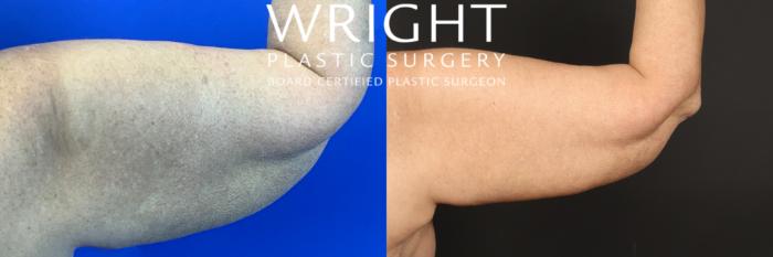Before & After Arm Lift Case 449 Right Side View in Little Rock, Arkansas