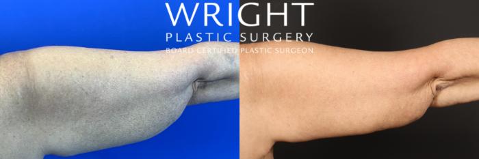Before & After Arm Lift Case 449 Right Side-arm View in Little Rock, Arkansas