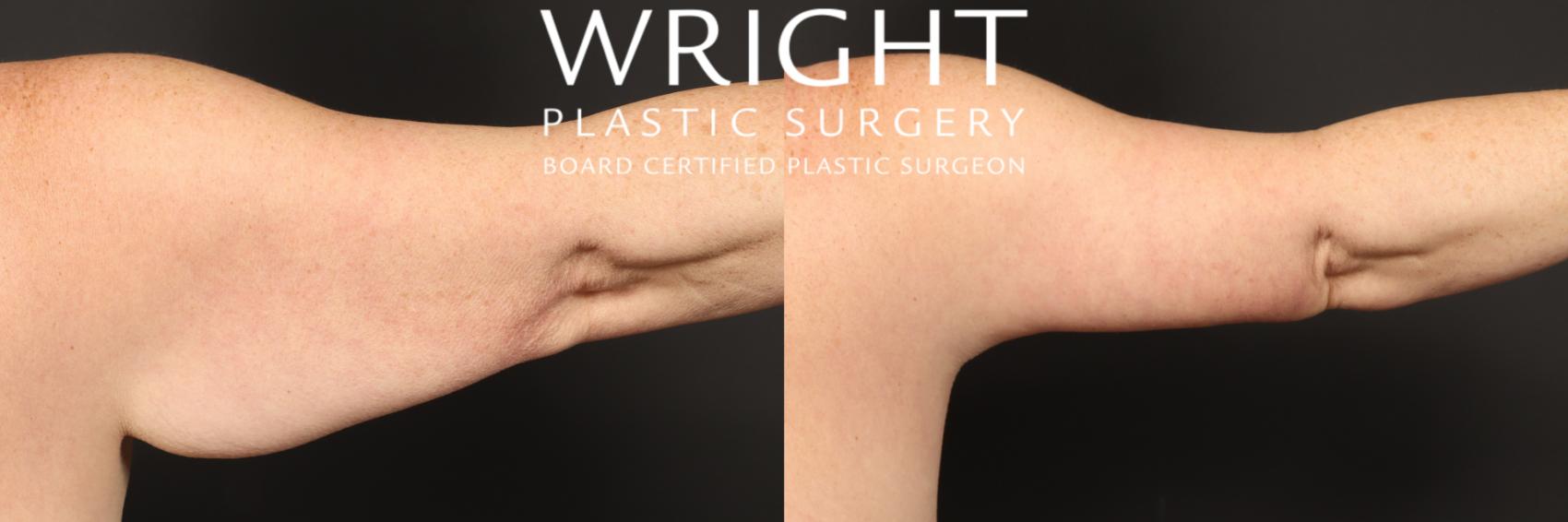 Before & After Liposuction Case 451 Right Side View in Little Rock, Arkansas