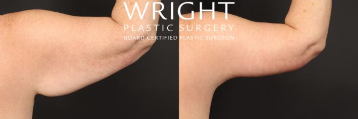 Before & After Liposuction Case 451 Right Side-arm View in Little Rock, Arkansas