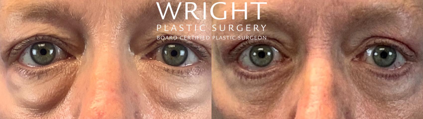 Before & After Blepharoplasty Case 190 Front View in Little Rock, Arkansas