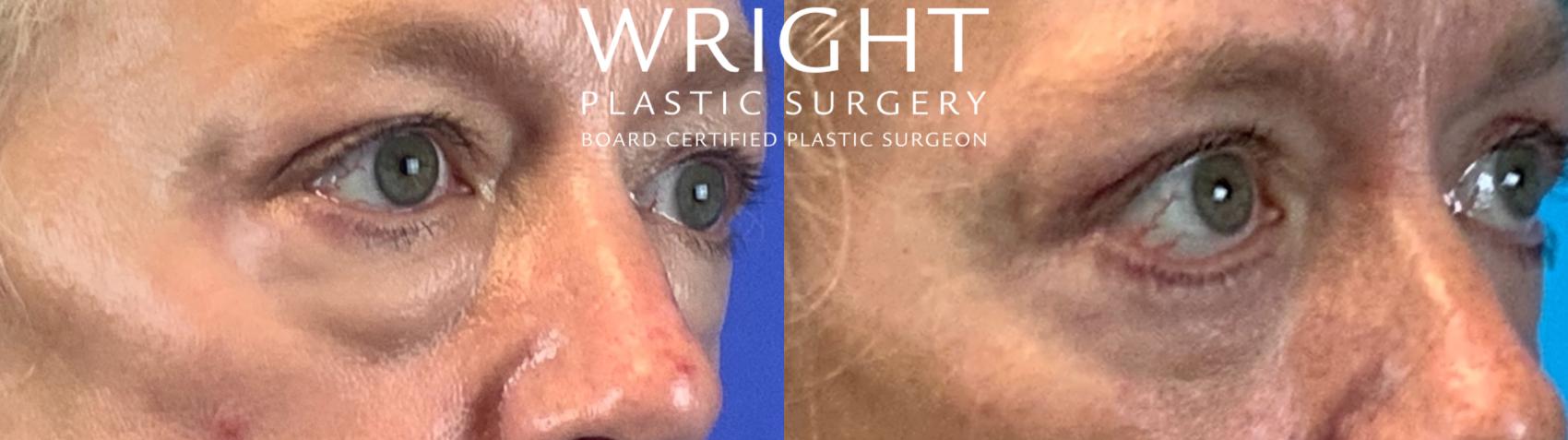 Before & After Blepharoplasty Case 190 Right Side View in Little Rock, Arkansas