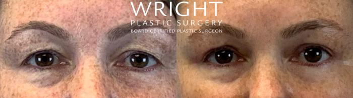 Before & After Blepharoplasty Case 255 Front View in Little Rock, Arkansas