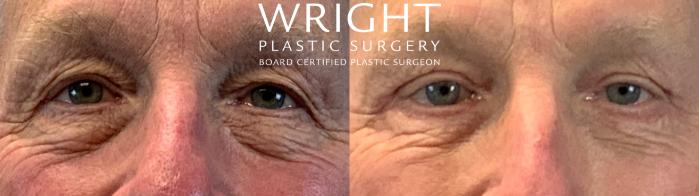 Before & After Blepharoplasty Case 303 Front View in Little Rock, Arkansas