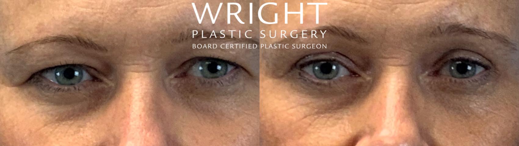 Before & After Blepharoplasty Case 311 Front View in Little Rock, Arkansas