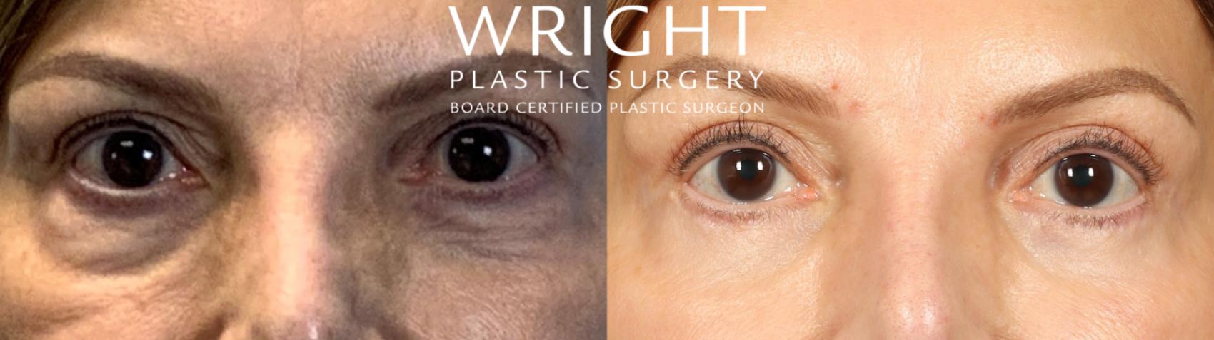 Before & After Blepharoplasty Case 446 Front View in Little Rock, Arkansas