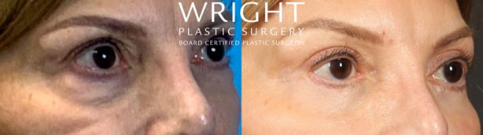 Before & After Blepharoplasty Case 446 Right Side View in Little Rock, Arkansas