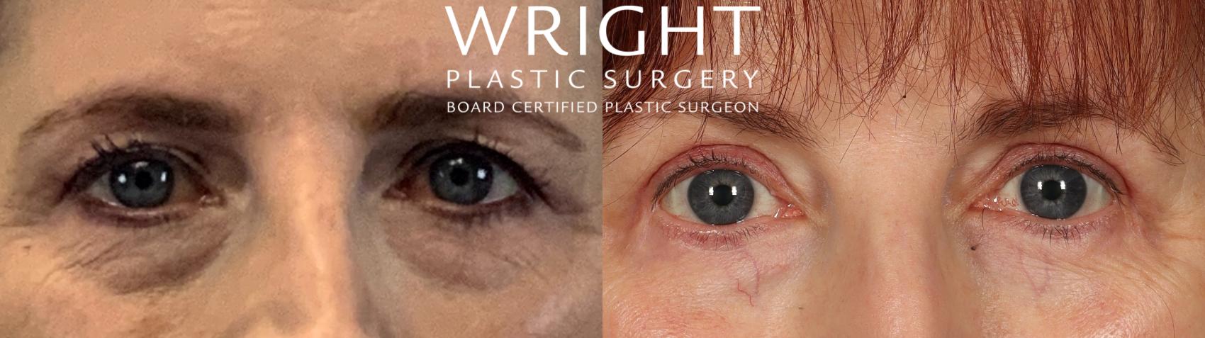 Before & After Blepharoplasty Case 474 Front View in Little Rock, Arkansas