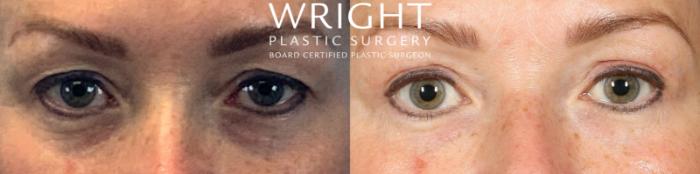 Before & After Blepharoplasty Case 535 Front View in Little Rock, Arkansas