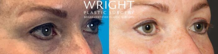 Before & After Blepharoplasty Case 535 Right Oblique View in Little Rock, Arkansas