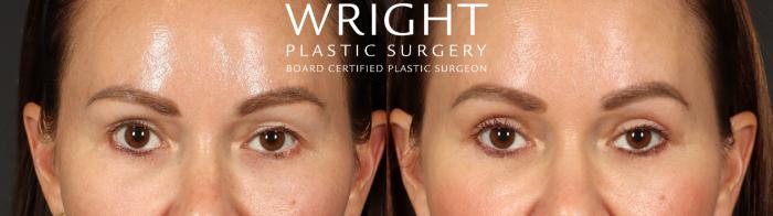 Before & After Blepharoplasty Case 683 Front View in Little Rock, Arkansas