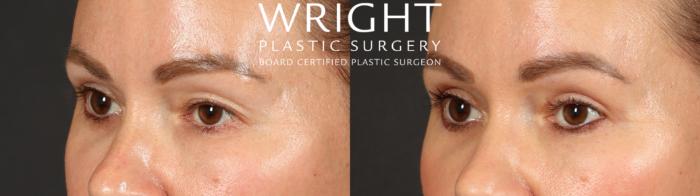 Before & After Blepharoplasty Case 683 Left Oblique View in Little Rock, Arkansas