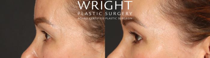 Before & After Blepharoplasty Case 683 Left Side View in Little Rock, Arkansas