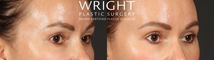 Before & After Blepharoplasty Case 683 Right Oblique View in Little Rock, Arkansas
