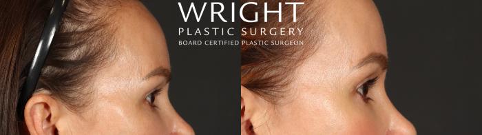 Before & After Blepharoplasty Case 683 Right Side View in Little Rock, Arkansas
