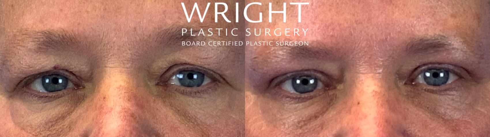 Before & After Blepharoplasty Case 97 Front View in Little Rock, Arkansas