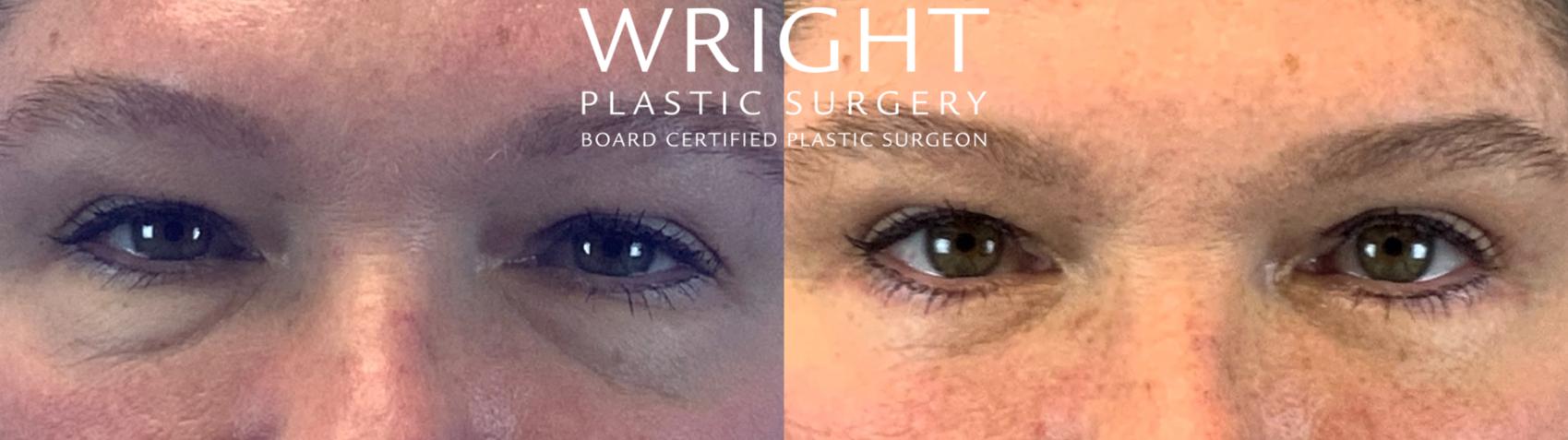 Before & After Blepharoplasty Case 99 Front View in Little Rock, Arkansas