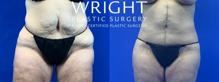 Before & After Liposuction Case 199 Front View in Little Rock, Arkansas