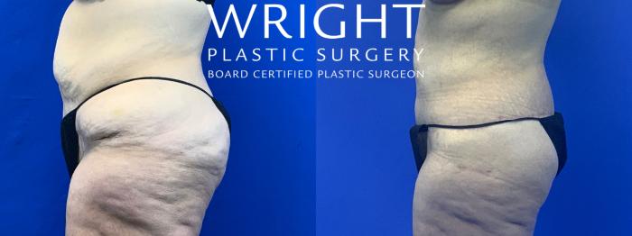 Before & After Liposuction Case 199 Left Side View in Little Rock, Arkansas