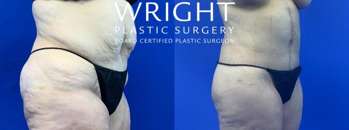 Before & After Liposuction Case 199 Right Oblique View in Little Rock, Arkansas