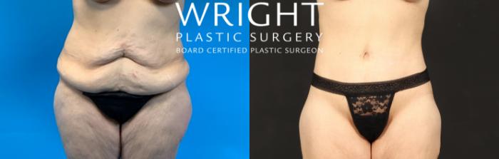 Before & After Liposuction Case 495 Front View in Little Rock, Arkansas