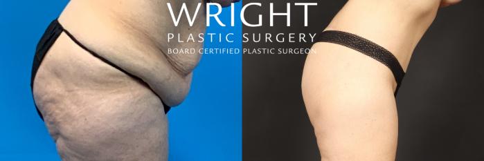 Before & After Liposuction Case 495 Right Side View in Little Rock, Arkansas