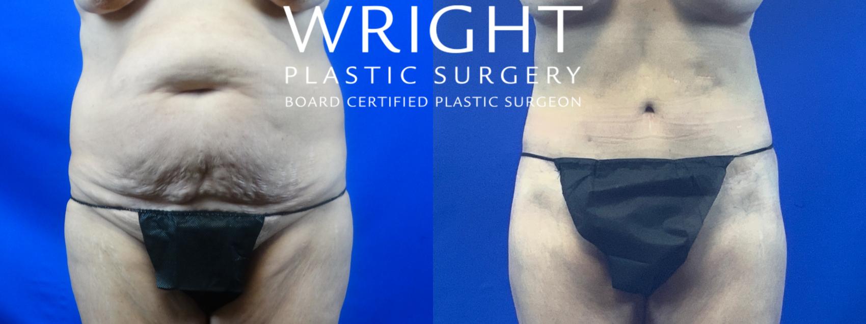 Preparing for Plastic Surgery - Little Rock, AR